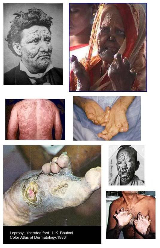 leprosy cure